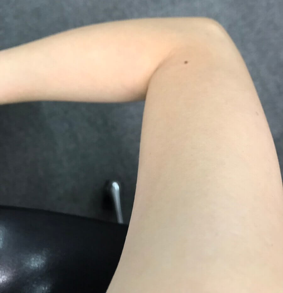 日焼け